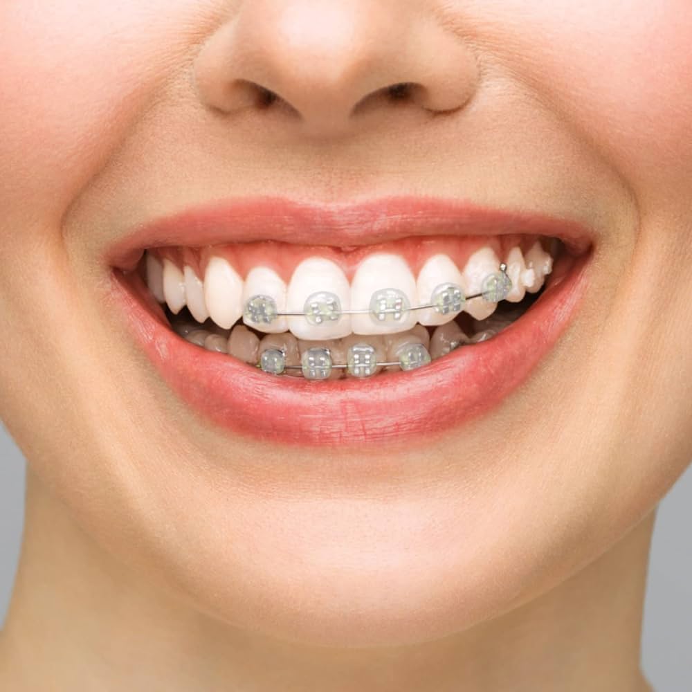 تاج شمع تقويم اسنان